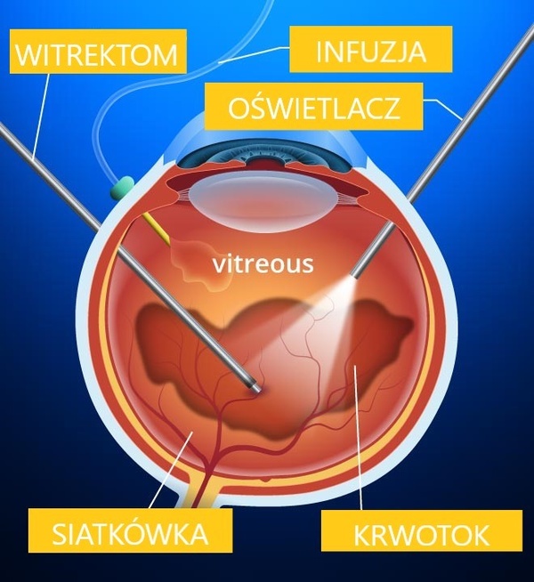 Witrektomia - operacja witrektomii, leczenie operacyjne siatkówki w Sosnowcu