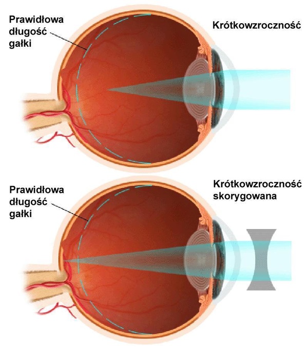 Krótkowzroczność / myopia - leczenie krótkowzroczności, ortosoczewki, okulary w krótkowzroczności w Sosnowcu