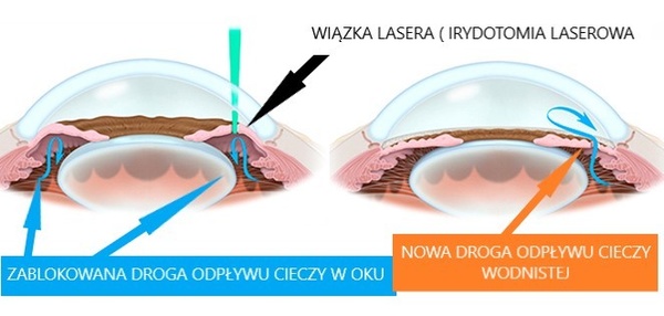 IRT/ irydotomia laserowa w Sosnowcu