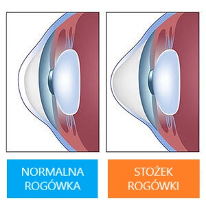 Stożek rogówki - diagnostyka, twarde soczewki, soczewki hybrydowe, cross linking w Sosnowcu